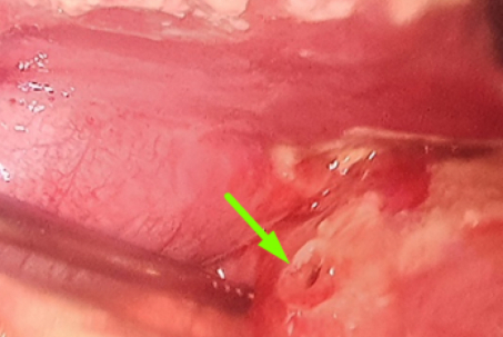 Căng thẳng ôn thi lớp 10, nam sinh nhập viện vì thủng hành tá tràng