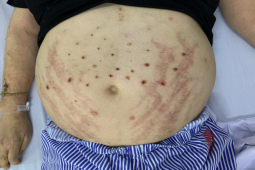 Sức khỏe đời sống - Nhập viện vì nghe thầy lang chữa bệnh bằng cách cho ong đốt