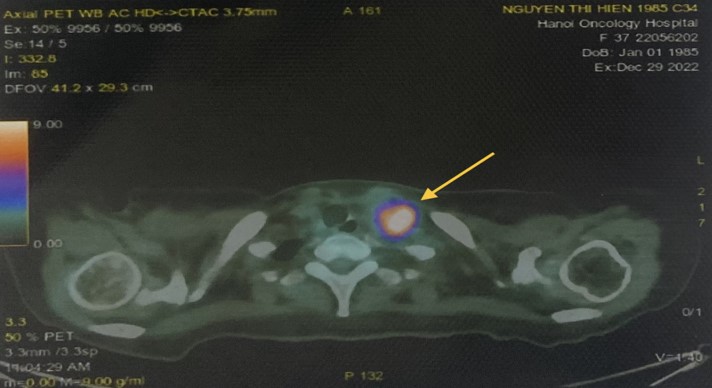 Hình ảnh chụp PET-CT: Hạch thượng đòn trái kích thước 26x28mm (mũi tên màu vàng).