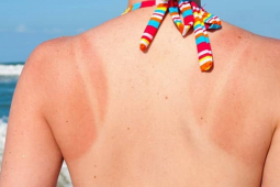 Đàn ông - 7 cách chữa cháy nắng giúp da hồi phục cực nhanh