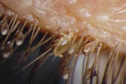 Sức khỏe đời sống - Người đàn ông 30 tuổi ngứa ngáy, phát hiện ổ rận mu ở “vùng kín”