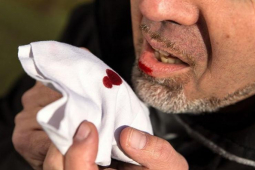 Sức khỏe đời sống - Cảnh báo ung thư thực quản cận kề: Đừng vì “đợi” trào ngược giảm mà hối hận không kịp!