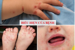 Sức khỏe đời sống - Dấu hiệu tay chân miệng diễn biến nặng cần nhập viện ngay