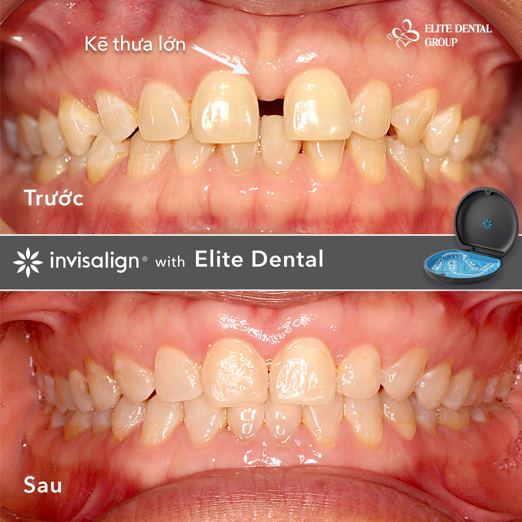 Bác sĩ Elite Dental ứng dụng niềng răng trong suốt Invisalign đóng khe thưa 5mm vùng răng cửa, giúp chị M.X tự tin cười tươi, ăn nhai thoải mái.