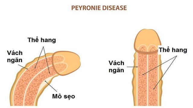 Tình dục có gặp khó khăn khi ‘cậu nhỏ’ của chàng không thẳng? - Ảnh 2.