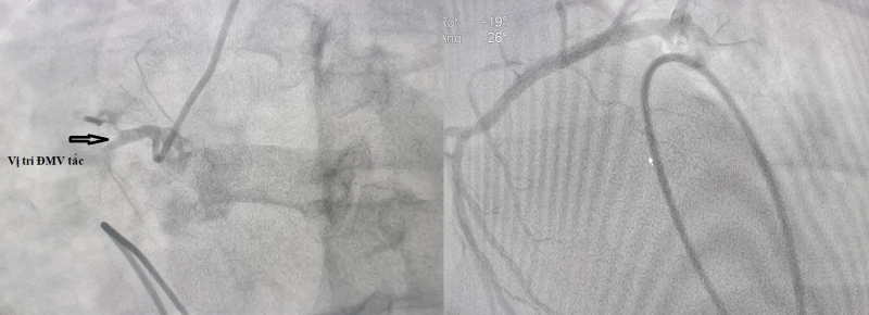 Hình ảnh chụp mạch vành của bệnh nhân trước và sau can thiệp.