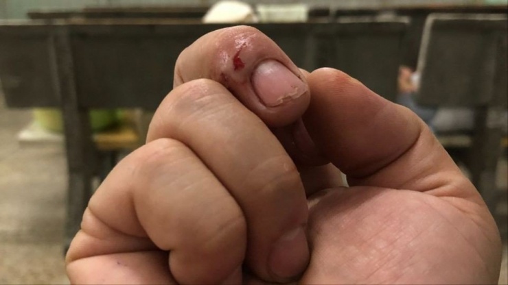 Trong quá trình giải cứu mèo rừng quý, ông L bị cắn vào tay, phải đi bệnh viện chích ngừa. Ảnh: HL