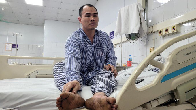 Công nhân Đàm Văn Đội đang điều trị ở Bệnh viện Đa khoa tỉnh Quảng Ninh sau sự cố ở Công ty Than Thống Nhất, ngày 3/4. Ảnh: Lê Tân