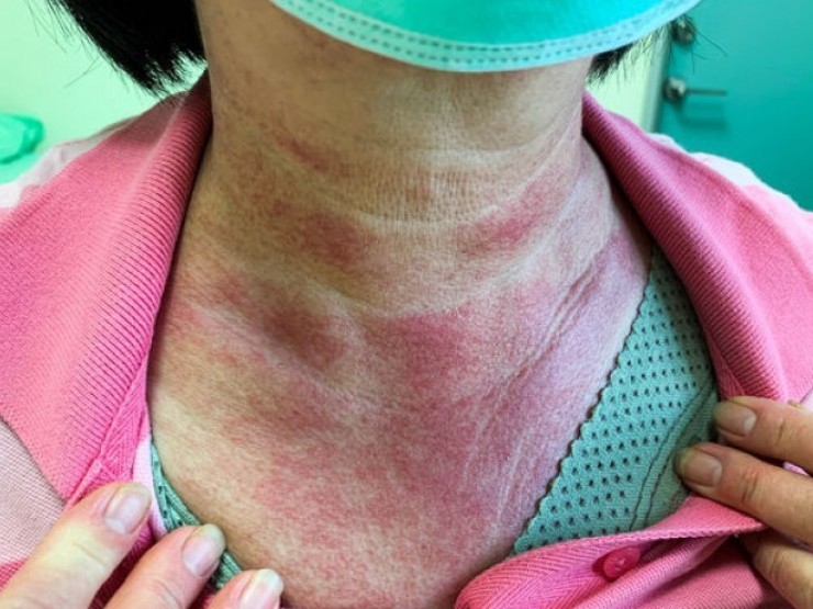 Thấy vết phát ban nổi trên mặt và ngực, không ngờ tế bào ung thư đã lan rộng