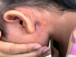 Một tài xế mắc bệnh vi khuẩn "ăn thịt người"