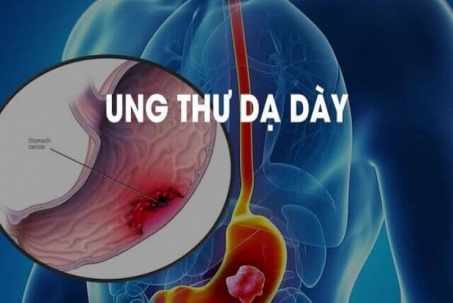 Ung thư dạ dày nguy hiểm là thế nhưng rất nhiều người hiểu sai những...