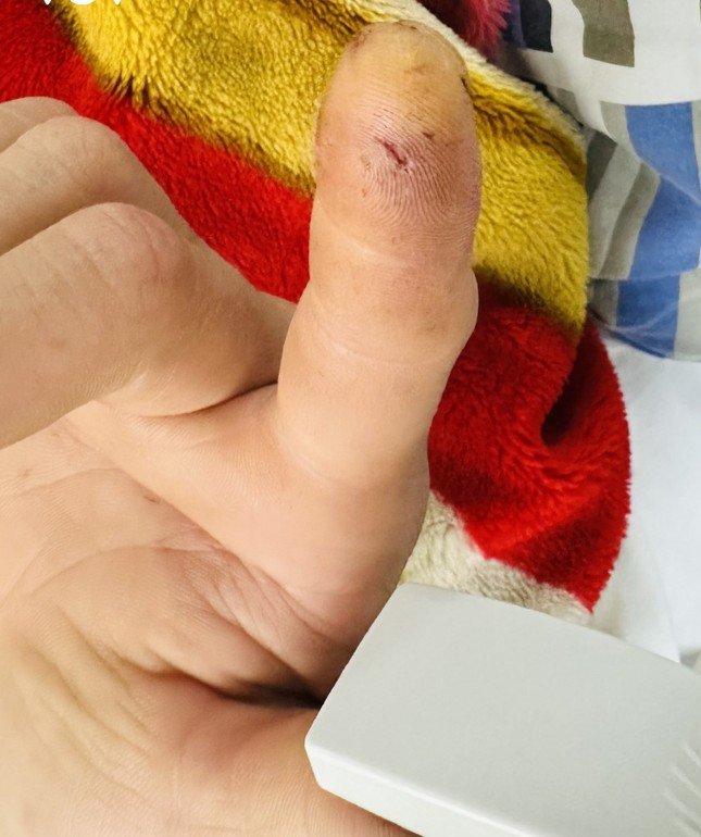 Hình ảnh ngón tay người đàn ông ở Cao Lộc, Lạng Sơn bị Cu li cắn (ảnh do Bệnh viện đa khoa Lạng Sơn cung cấp)
