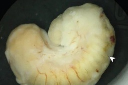 Sức khỏe đời sống - Thói quen ăn thịt cá sấu, cô gái có ký sinh trùng trong mắt suốt 2 năm mà không hề biết