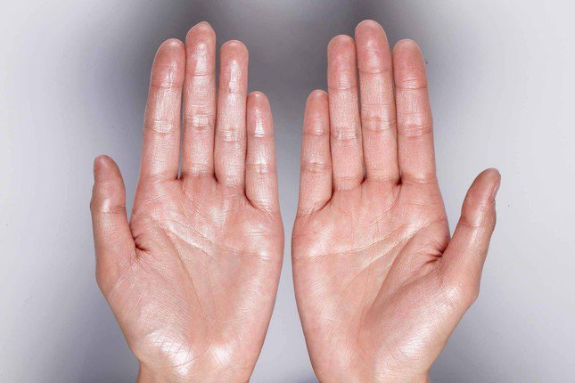 Có nhiều phương pháp trị dứt điểm chứng ra mồ hôi tay.