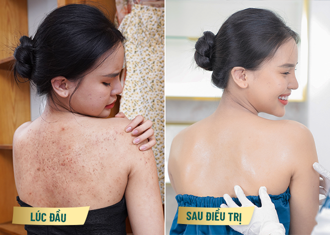 Chị Thanh Thủy (Quận 1) vỡ òa với kết quả trị viêm da sạch không còn các vết viêm thâm và mẩn ngứa sau 1 liệu trình 3 buổi với phác đồ điều trị với Smooth Ultra