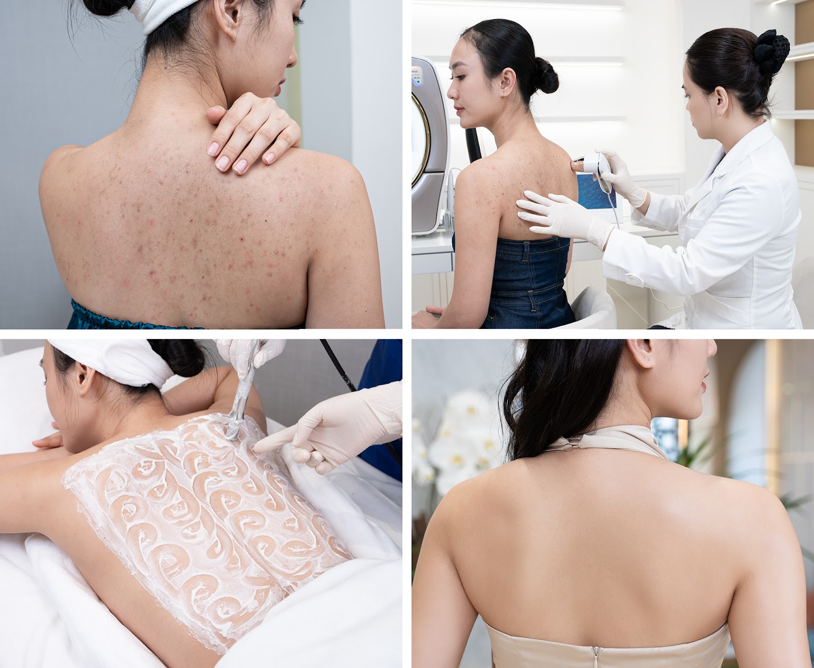 Hàng triệu chị em phụ nữ Việt đã tin tưởng và lựa chọn công nghệ trị viêm da, viêm nang lông Smooth Ultra và gặt hái được kết quả thay đổi ngoạn mục&nbsp;