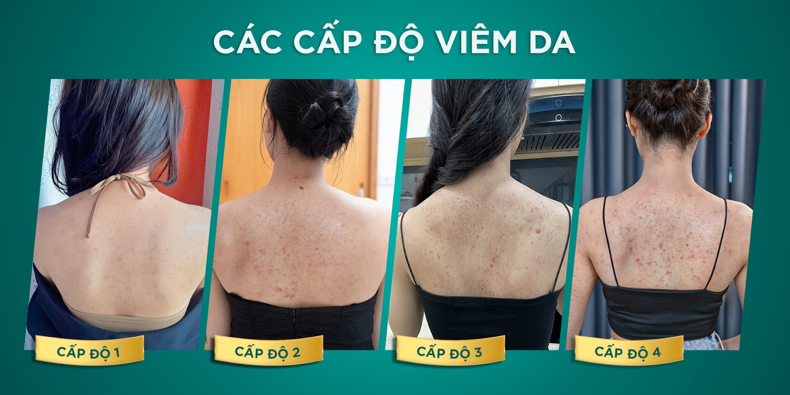 Viêm da có nhiều cấp độ và tùy thuộc vào tình trạng nặng nhẹ số buổi trị liệu khác nhau việc điều trị càng được tiến hành sớm càng cho kết quả tốt&nbsp;