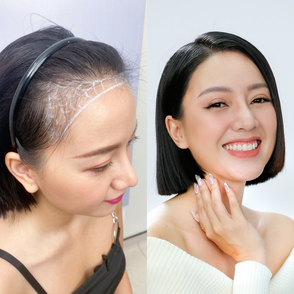 Diễn viên Băng Di lấy lại sự tự tin với mái tóc sau khi cấy tóc tự thân