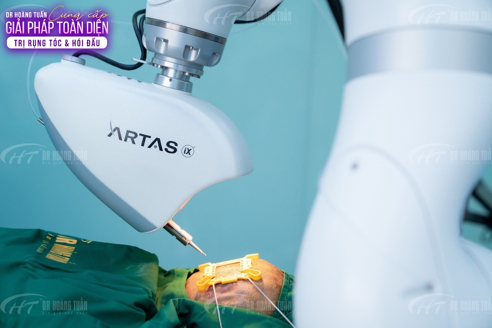 Xu hướng cấy tóc tiên tiến trên thế giới năm 2024 - 2