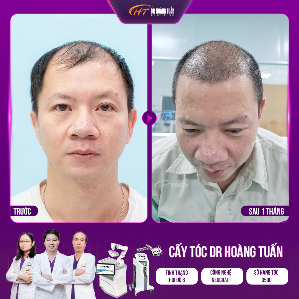 Xu hướng cấy tóc tiên tiến trên thế giới năm 2024 - 3