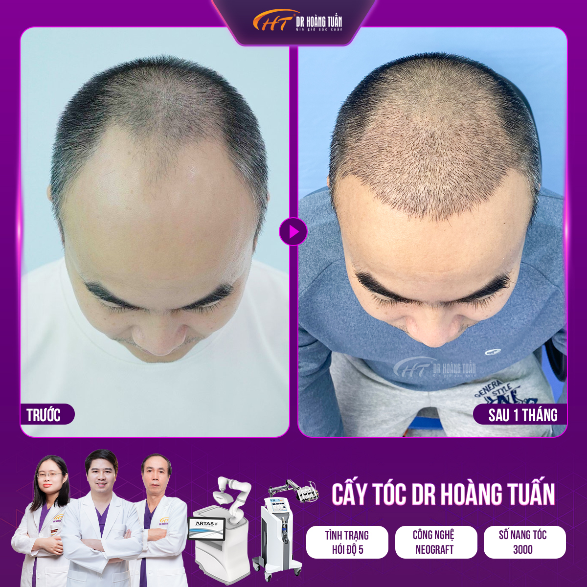 Xu hướng cấy tóc tiên tiến trên thế giới năm 2024 - 4