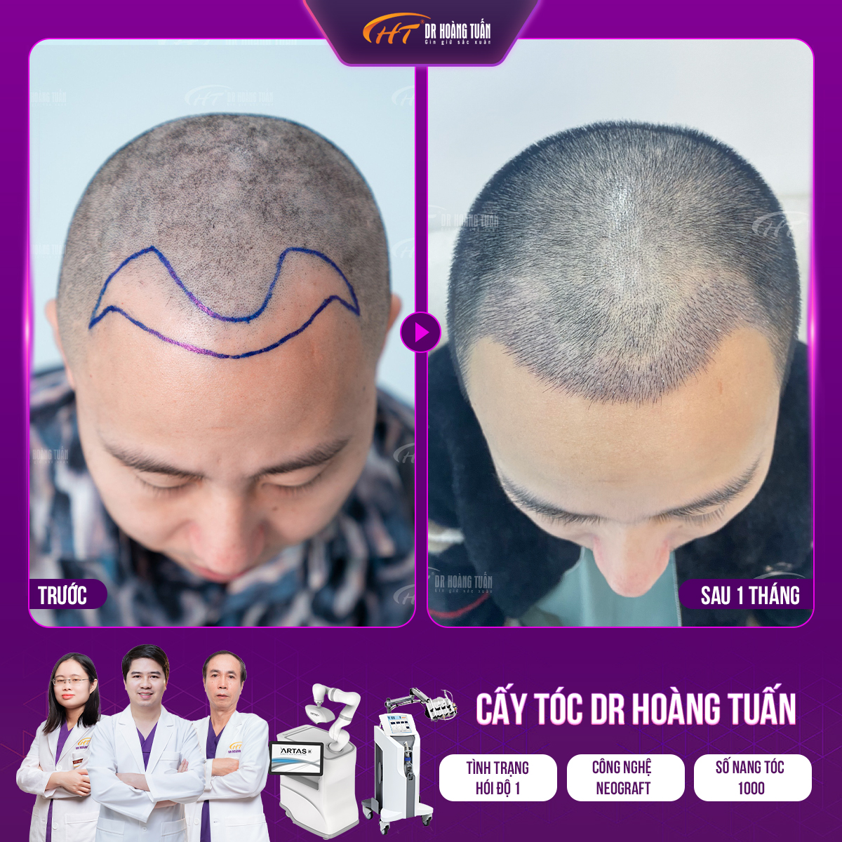 Xu hướng cấy tóc tiên tiến trên thế giới năm 2024 - 5