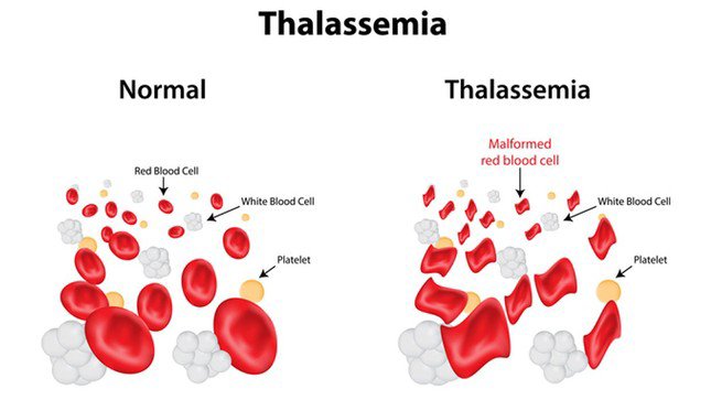 Sự khác nhau giữa các tế bào máu bình thường (bên trái) và tế bào máu Thalassemia.