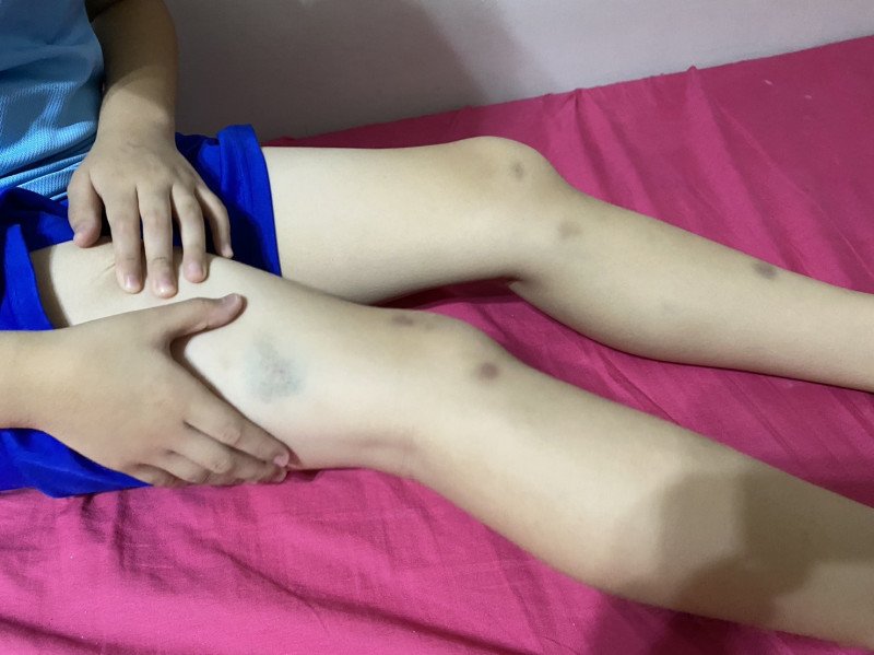 Cậu bé có vết bầm tím không rõ nguyên nhân trên tay chân.