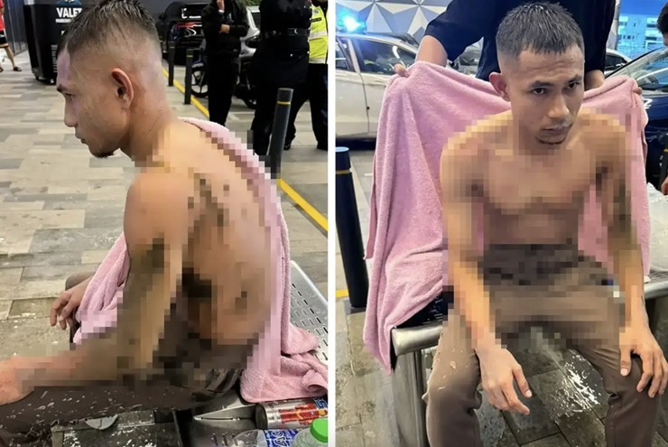 Hình ảnh Faisal Halim sau khi bị tấn công bằng axit