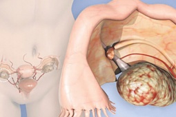 Sức khỏe đời sống - Vì sao chị em bị ung thư phụ khoa?