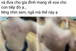 Tin tức trong ngày - Công an vào cuộc làm rõ vụ học sinh mầm non lớp 5 tuổi bị bầm tím vùng lưng