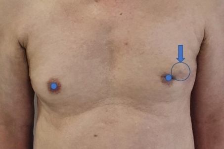 Những ai có nguy cơ mắc ung thư vú ở nam giới?