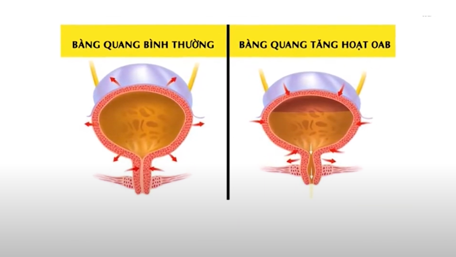 Bàng quang tăng hoạt OAB là tình trạng bàng quang co bóp liên tục và đột ngột ngay cả khi chưa đổ đầy nước tiểu.&nbsp;