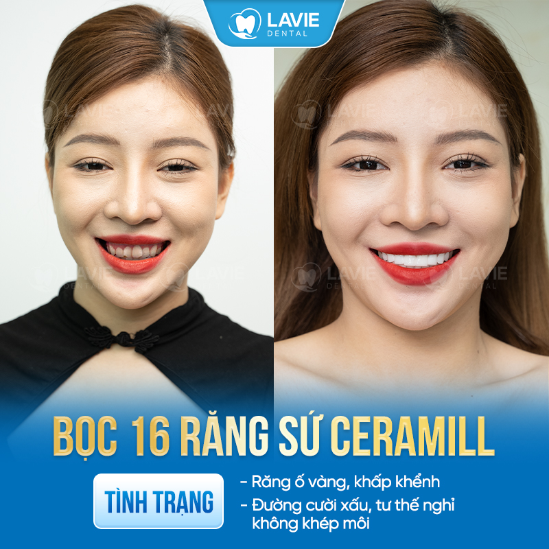 Khách hàng Trịnh Bích sau khi bọc 16 răng sứ CERAMILL