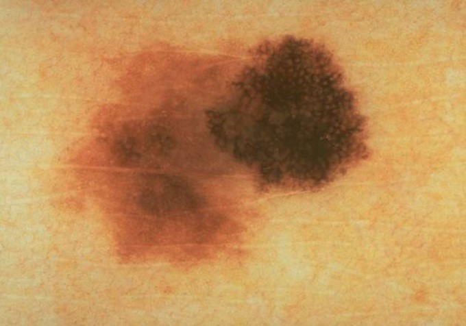 Hình ảnh đặc trưng của nốt ruồi không đối xứng cảnh báo ung thư da. Ảnh: American Academy of Dermatology