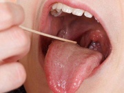 Sức khỏe đời sống - 12 câu hỏi thường gặp về bệnh ung thư lưỡi