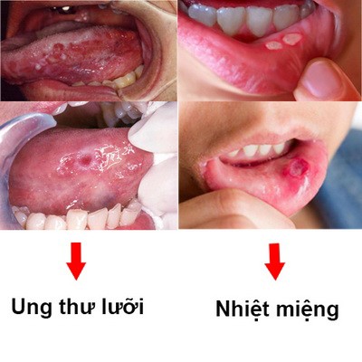 12 câu hỏi thường gặp về bệnh ung thư lưỡi- Ảnh 3.