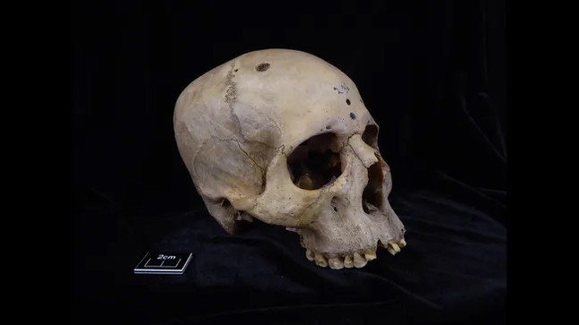 Một trong những hộp sọ thuộc về một người đàn ông sống trong khoảng thời gian từ năm 2686 đến năm 2345 trước Công nguyên có vết cắt để điều trị ung thư. (Ảnh: Tondini, Isidro, Camarós).