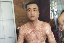 Tin tức trong ngày - Nghị lực sống của chàng trai từng lao vào biển lửa cứu mẹ