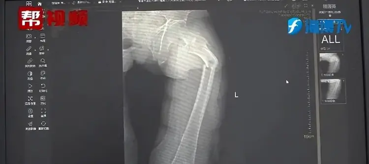 Kết quả chụp X-quang cho thấy anh Ye bị gãy xương đùi.