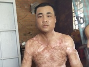 Tin tức trong ngày - Nghị lực sống của chàng trai từng lao vào biển lửa cứu mẹ
