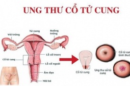 Sức khỏe đời sống - Độ tuổi nào phụ nữ cần tầm soát ung thư cổ tử cung?