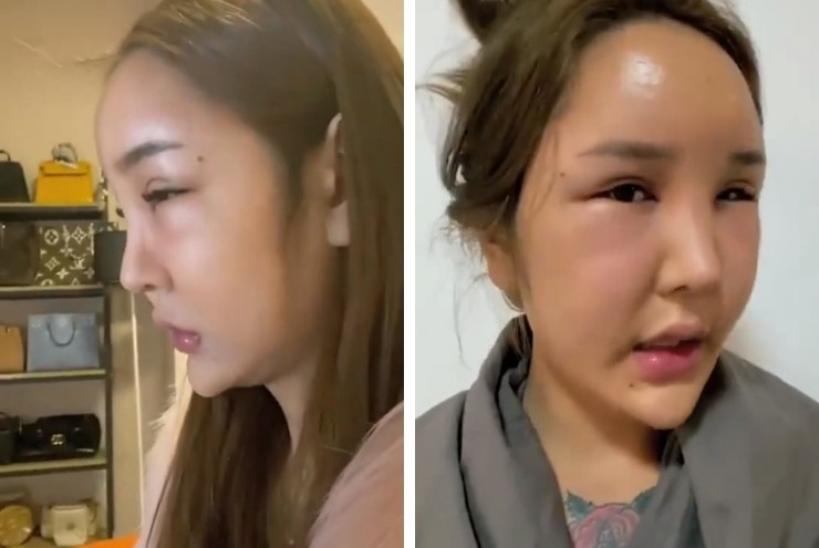 Cô Mạnh hối hận khi tiêm quá nhiều thứ vào mông mình.