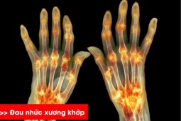 Tin tức sức khỏe - Sưng đau nhiều khớp chân tay - người phụ nữ Đồng Nai bất ngờ khi biết mắc bệnh xương khớp!