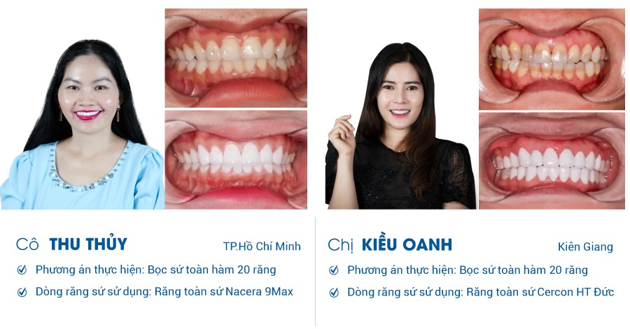 Khách hàng bọc răng sứ tại nha khoa I-Dent DiamondTech