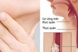 Người đàn ông phát hiện ung thư thực quản thừa nhận 1 sai lầm mà nhiều người Việt đang mắc phải