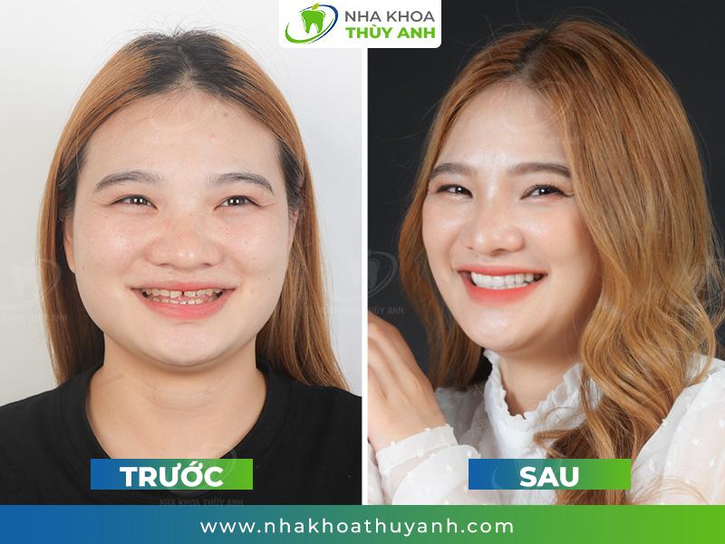 Bọc răng sứ thẩm mỹ đẹp tự nhiên, an toàn tại nha khoa Thùy Anh - 4