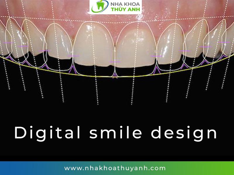 Bọc răng sứ thẩm mỹ đẹp tự nhiên, an toàn tại nha khoa Thùy Anh - 3