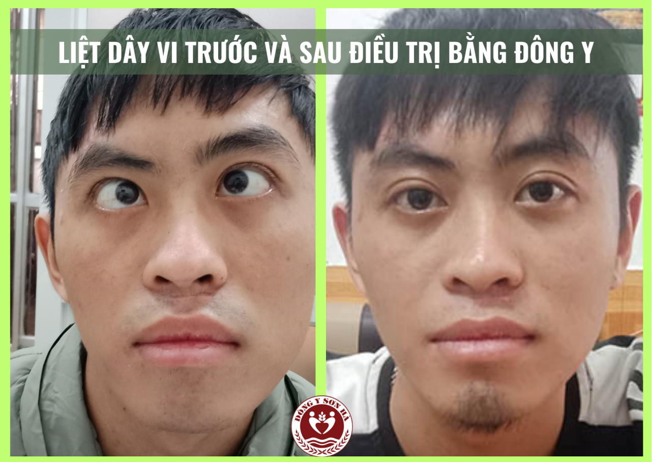 Tại sao liệt dây thần kinh số 6 gây lác trong - 2