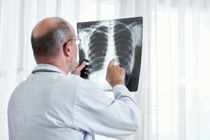 Bác sĩ xem ảnh chụp X-quang lồng ngực của một bệnh nhân. Ảnh: Chestmed